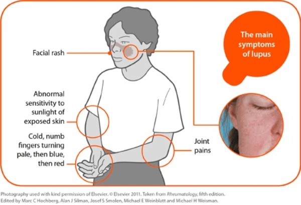 Lupus Facial Rash