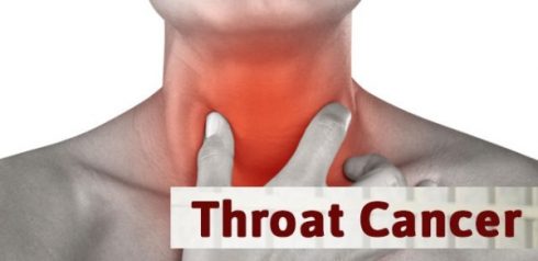 throat tumor chapman checker symptom eposts laryngeal