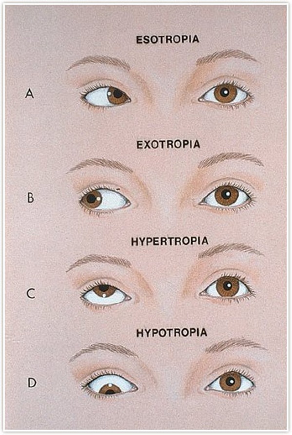 How To Know If You Have A Lazy Eye