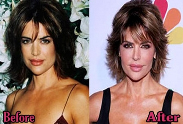 free lisa rinna plastic surgery