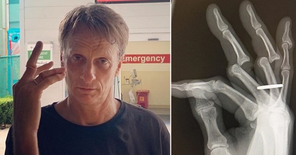 Why did Tony Hawk, American skateboarder get his wedding ring sliced ...